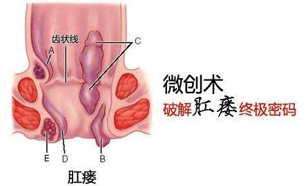 福清肛瘘应该怎么预防？