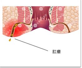 福清一般是怎么治疗肛瘘的?