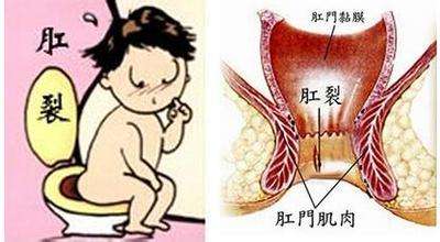 福清治疗肛裂的费用是多少？