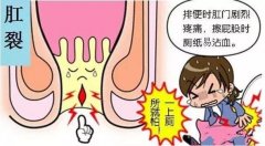 福清哪家医院治疗肛裂效果好